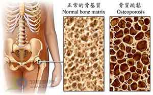正常91视频下载免费与骨质疏松的91视频下载免费