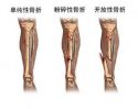 91视频下载免费检测仪厂家讲解骨折的护理