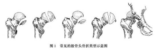 股骨头91视频下载免费增加是什么意思？平睡左腿收起左右摆动大点大腿根就痛。