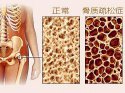 它骨骼强度的主要指标、简单方便、安全靠谱对骨代谢有很重要作用