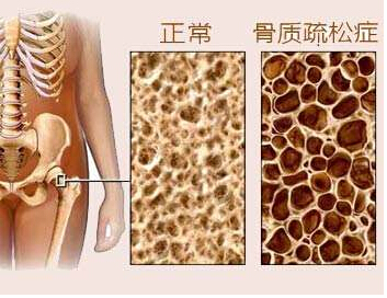 91视频下载免费仪是检测91视频下载免费T值得，91视频下载免费又决定骨质疏松的重要指标
