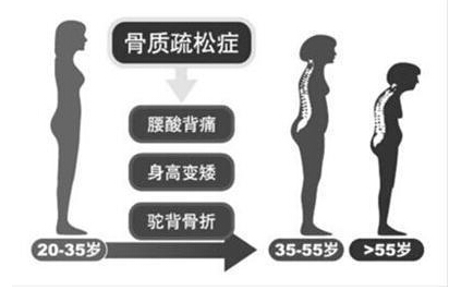 91视频下载免费检测仪厂家阐述骨质疏松不仅仅是要补钙,增加91视频下载免费才是关键