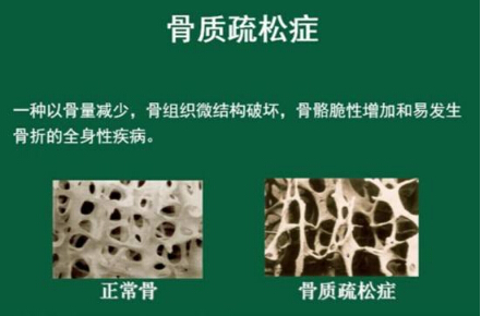 91视频下载免费仪怎么样检测骨质疏松，能够正确的分析91视频下载免费正常值