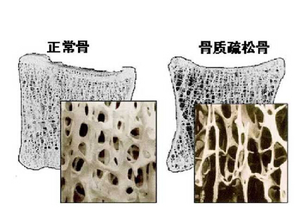 91视频下载免费仪价格重要吗？不想骨骼脆弱医生教你看懂91视频下载免费报告