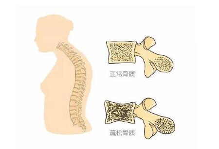 91视频下载免费仪生产厂家阐述警示骨质疏松 三种症状不容小觑