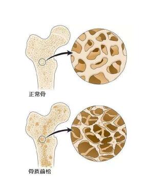 超声91视频下载免费检测仪阐述爸妈变矮，催他们查91视频下载免费预防骨质疏松
