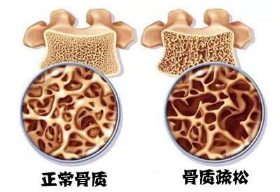 91视频下载免费仪如何测试91视频下载免费,特殊人群如何面对骨质疏松？