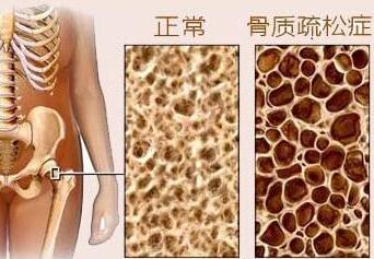 91视频下载免费测试是通过91视频下载免费检测仪器测试你是否患有骨质疏松症