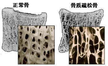 91视频下载免费分析仪的价格是多少，要小心提防骨质疏松影响工作和生活