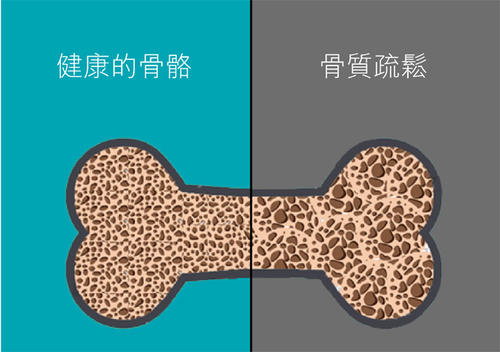 老年人骨质疏松易导致骨折之超声91视频下载免费检查仪的临床价值是什么？