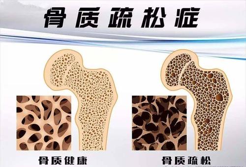 国产91视频下载免费仪器有效预防骨质疏松症依赖于定期的91视频下载免费测试