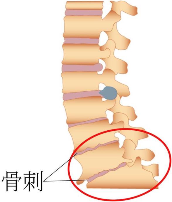 吉林长春|91视频污污污超声91视频下载免费仪厂家品牌分享:为什么现在的年轻人也存在骨刺增生?